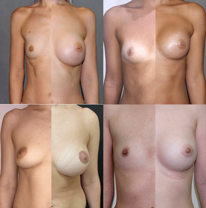 Foto antes e despois da mammaloplastia