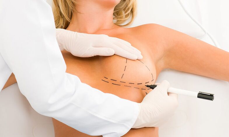 Mammoplastia -Breast Marking