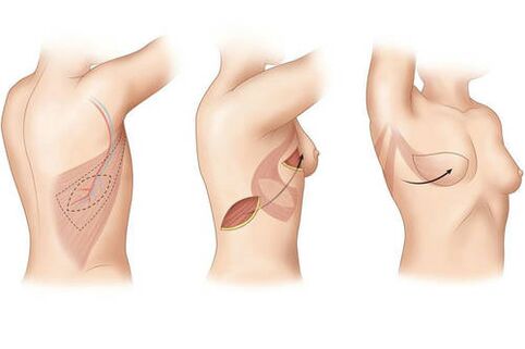 Tipos de cortes para a mamoplastia