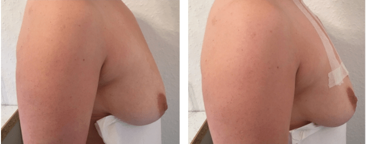 Antes e despois do fío levantamento de peito