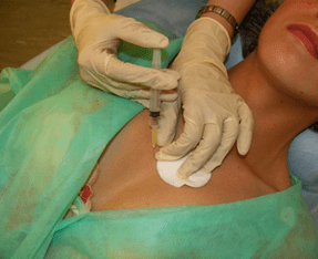 Introducir un meso-cóctel no tecido mamario unha alternativa ás inxeccións de ácido hialurónico