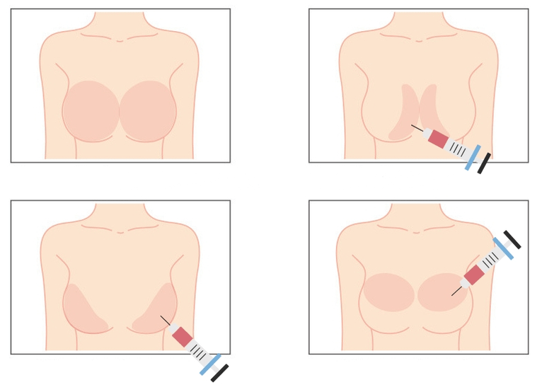 Sitios para inxectar ácido hialurónico no peito