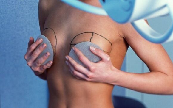 Aumento de mama con implantes