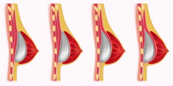 Métodos de colocación de implantes para a ampliación de mama